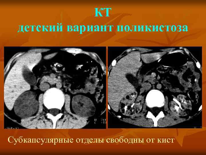 КТ детский вариант поликистоза Субкапсулярные отделы свободны от кист 