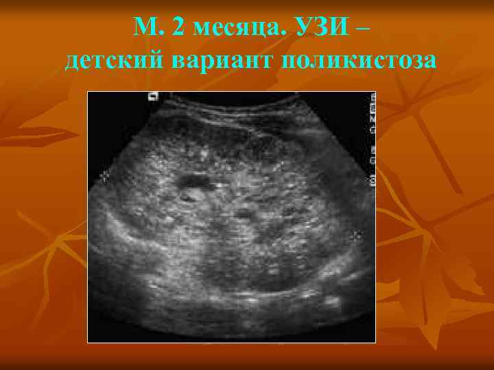 М. 2 месяца. УЗИ – детский вариант поликистоза 