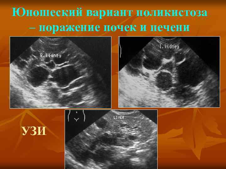 Юношеский вариант поликистоза – поражение почек и печени УЗИ 