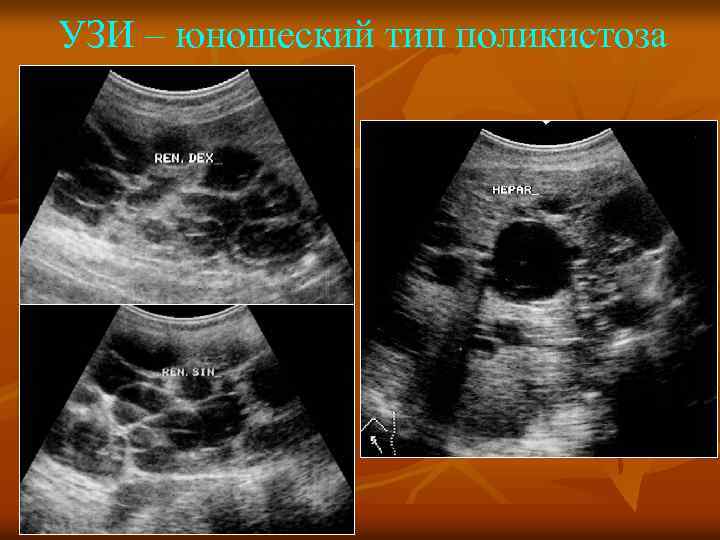 УЗИ – юношеский тип поликистоза 