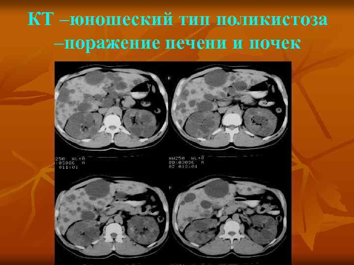 КТ –юношеский тип поликистоза –поражение печени и почек 