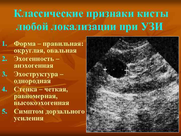 Классические признаки кисты любой локализации при УЗИ 1. Форма – правильная: округлая, овальная 2.
