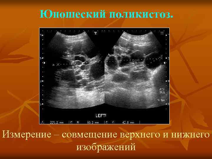 Юношеский поликистоз. Измерение – совмещение верхнего и нижнего изображений 