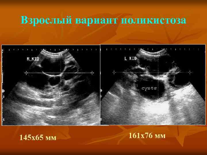 Взрослый вариант поликистоза 145 х65 мм 161 х76 мм 