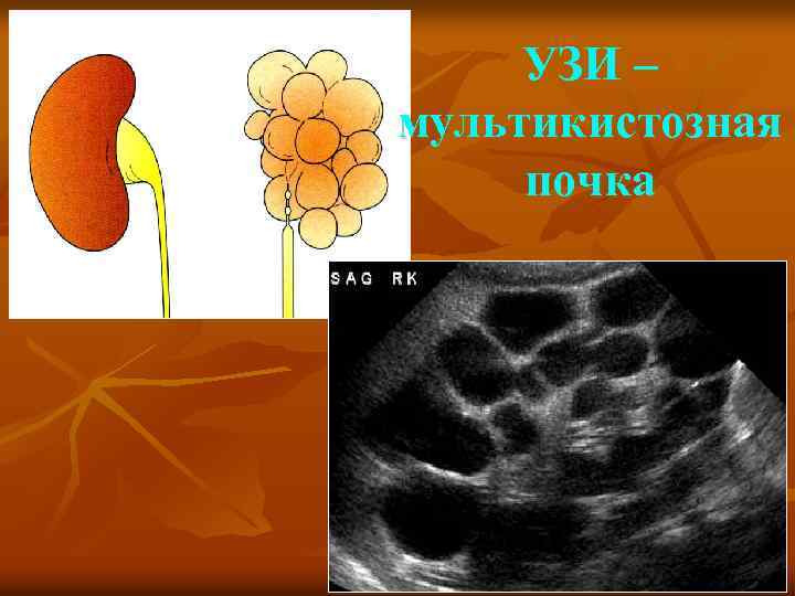 УЗИ – мультикистозная почка 
