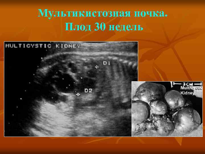 Мультикистозная почка. Плод 30 недель 