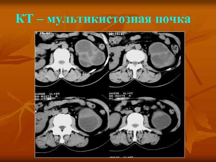 КТ – мультикистозная почка 