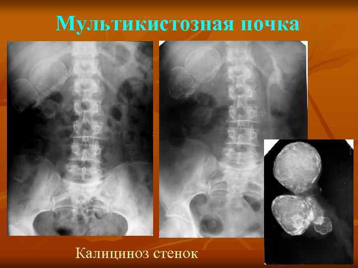 Мультикистозная почка Калициноз стенок 