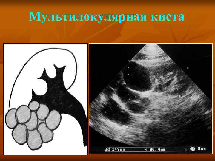 Мультилокулярная киста 