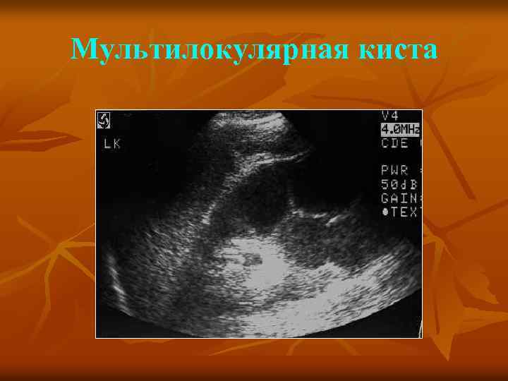 Мультилокулярная киста 
