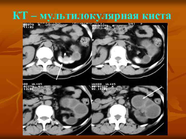 КТ – мультилокулярная киста 