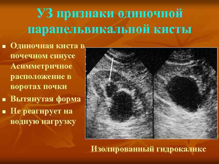 УЗ признаки одиночной парапельвикальной кисты n n n Одиночная киста в почечном синусе Асимметричное