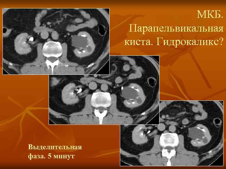 МКБ. Парапельвикальная киста. Гидрокаликс? Выделительная фаза. 5 минут 