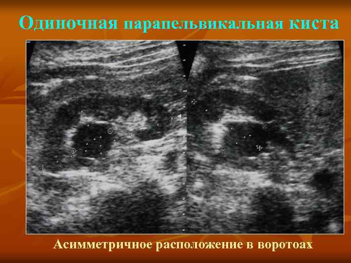 Одиночная парапельвикальная киста Асимметричное расположение в воротоах 