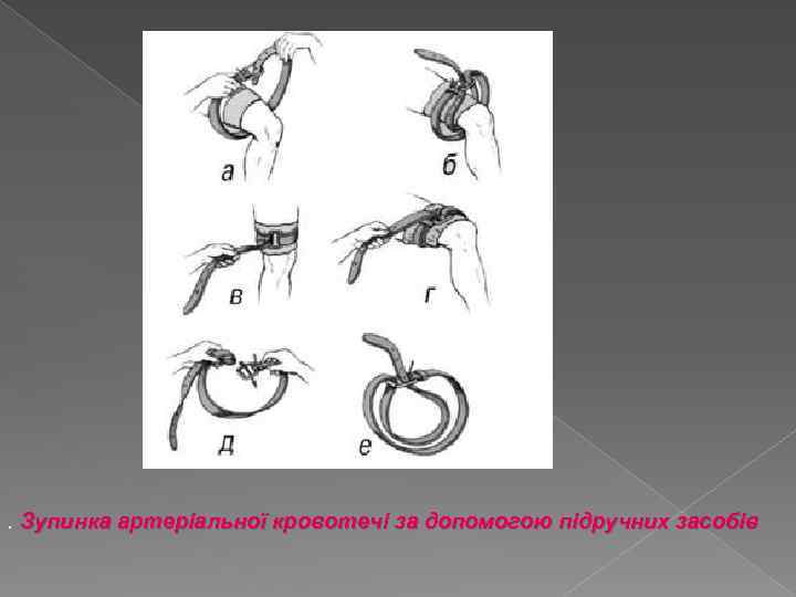 . Зупинка артеріальної кровотечі за допомогою підручних засобів 