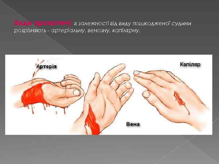 Види кровотечі: в залежності від виду пошкодженої судини розрізняють - артеріальну, венозну, капілярну. 