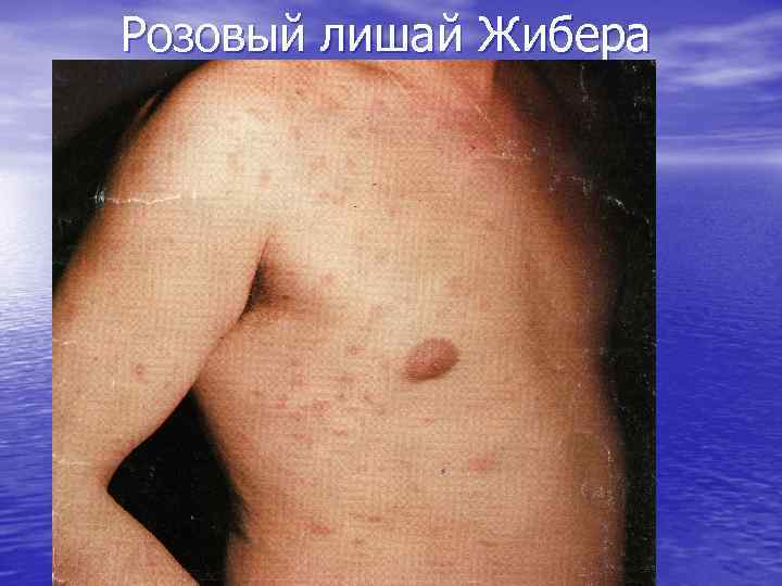 Розовый лишай Жибера 