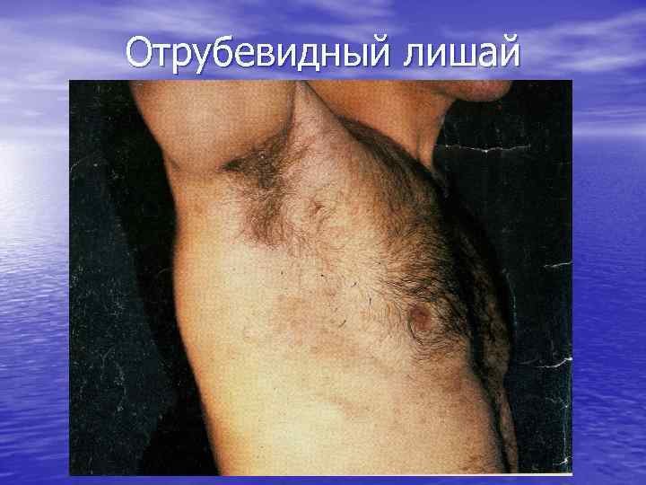 Отрубевидный лишай 