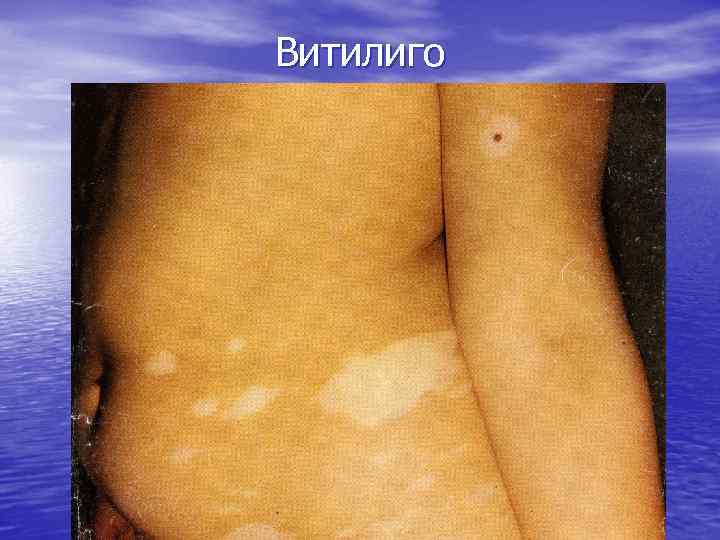 Витилиго 