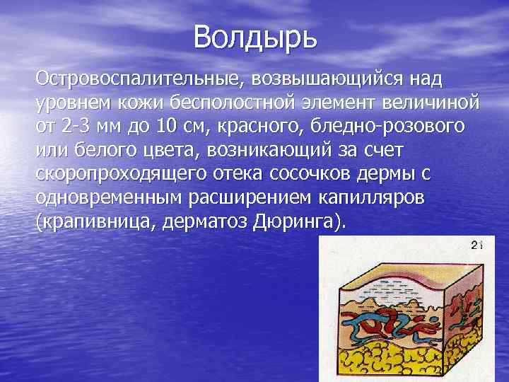 Волдырь Островоспалительные, возвышающийся над уровнем кожи бесполостной элемент величиной от 2 3 мм до