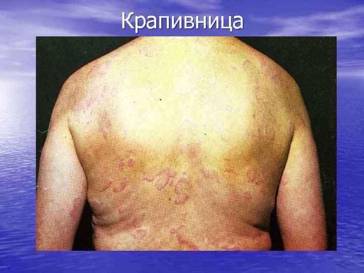 Крапивница 