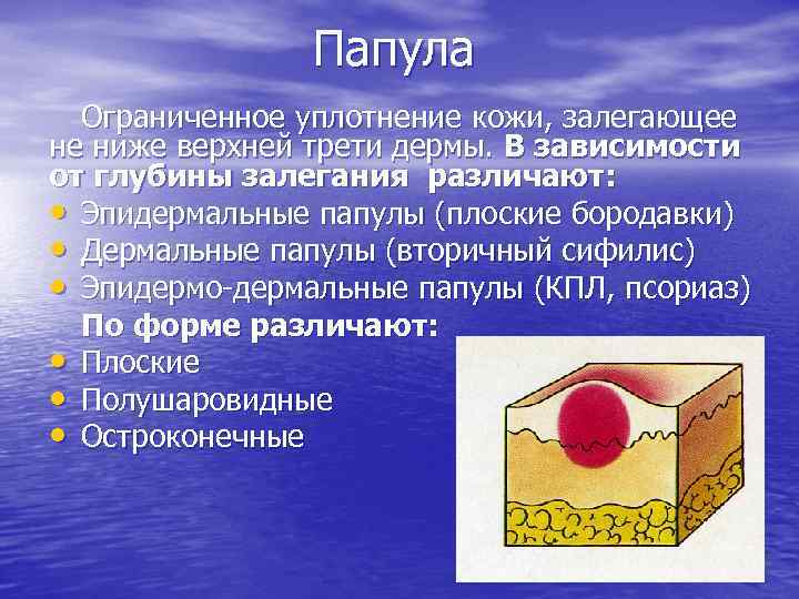 Папула Ограниченное уплотнение кожи, залегающее не ниже верхней трети дермы. В зависимости от глубины