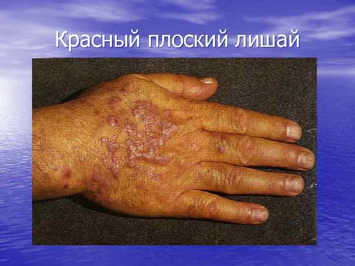 Красный плоский лишай 