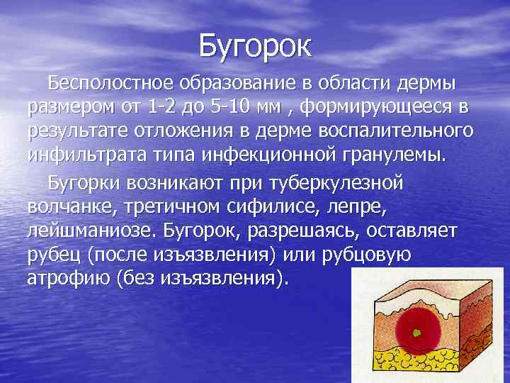 Бугорок Бесполостное образование в области дермы размером от 1 2 до 5 10 мм