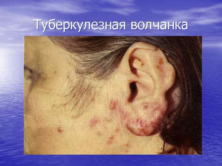 Туберкулезная волчанка 