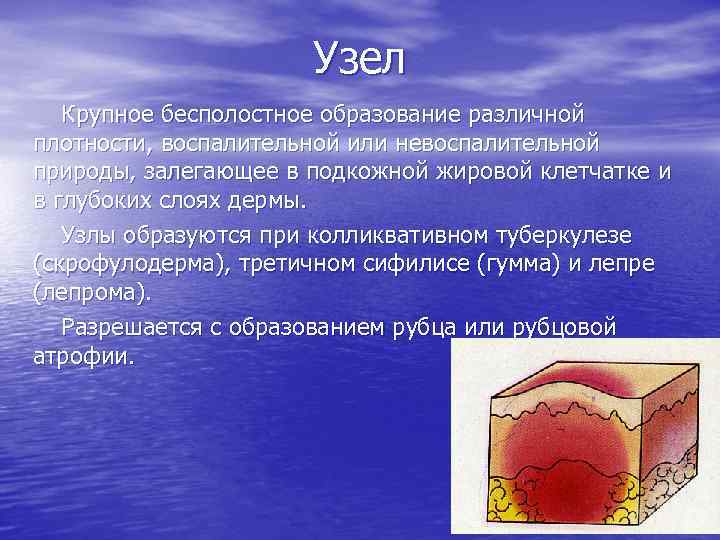Узел Крупное бесполостное образование различной плотности, воспалительной или невоспалительной природы, залегающее в подкожной жировой