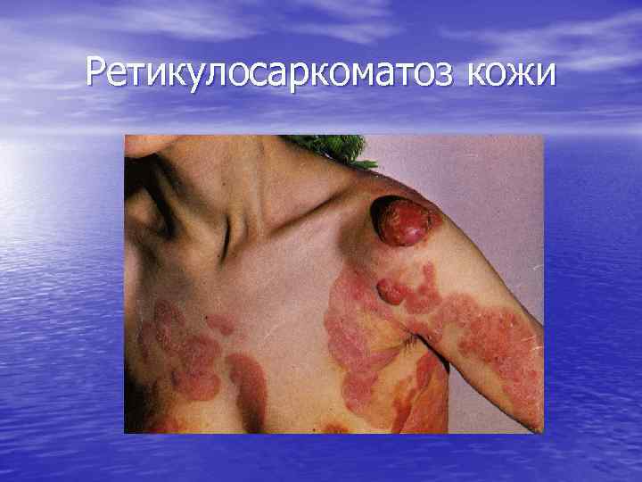 Ретикулосаркоматоз кожи 