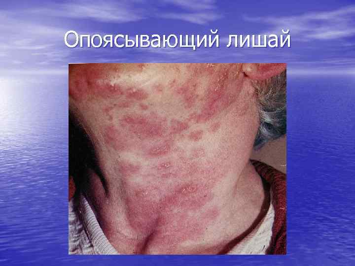 Опоясывающий лишай 