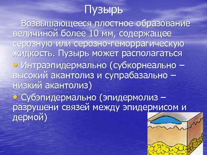 Пузырь Возвышающееся плостное образование величиной более 10 мм, содержащее серозную или серозно геморрагическую жидкость.