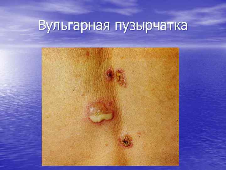 Вульгарная пузырчатка 