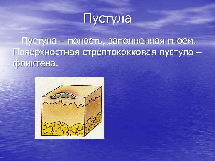 Пустула – полость, заполненная гноем. Поверхностная стрептококковая пустула – фликтена. 