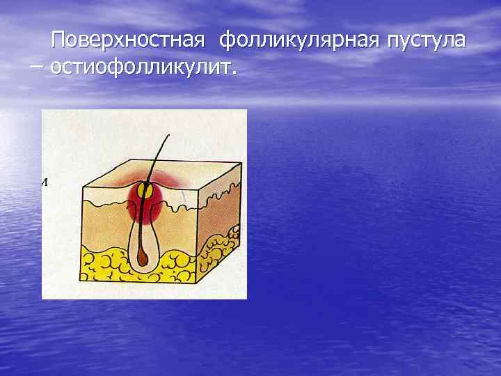 Поверхностная фолликулярная пустула – остиофолликулит. 