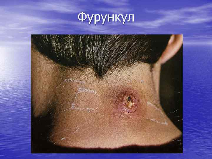 Фурункул 