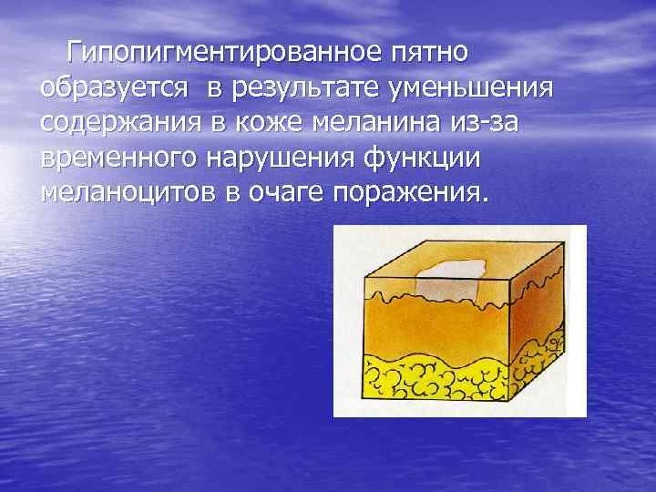Гипопигментированное пятно образуется в результате уменьшения содержания в коже меланина из за временного нарушения