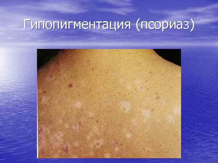 Гипопигментация (псориаз) 