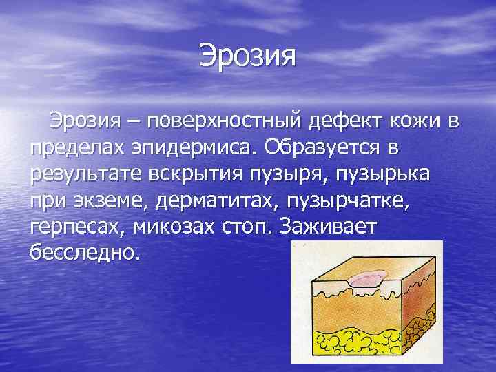 Эрозия – поверхностный дефект кожи в пределах эпидермиса. Образуется в результате вскрытия пузыря, пузырька