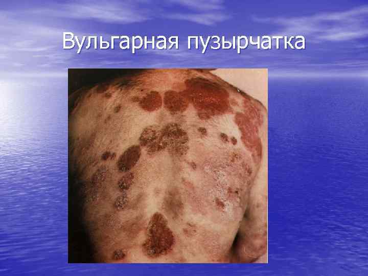 Вульгарная пузырчатка 
