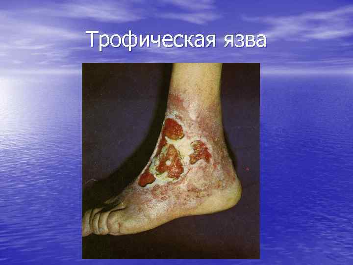 Трофическая язва 