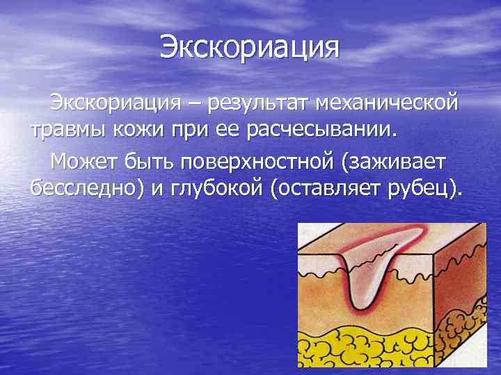 Экскориация – результат механической травмы кожи при ее расчесывании. Может быть поверхностной (заживает бесследно)