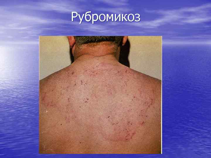 Рубромикоз 