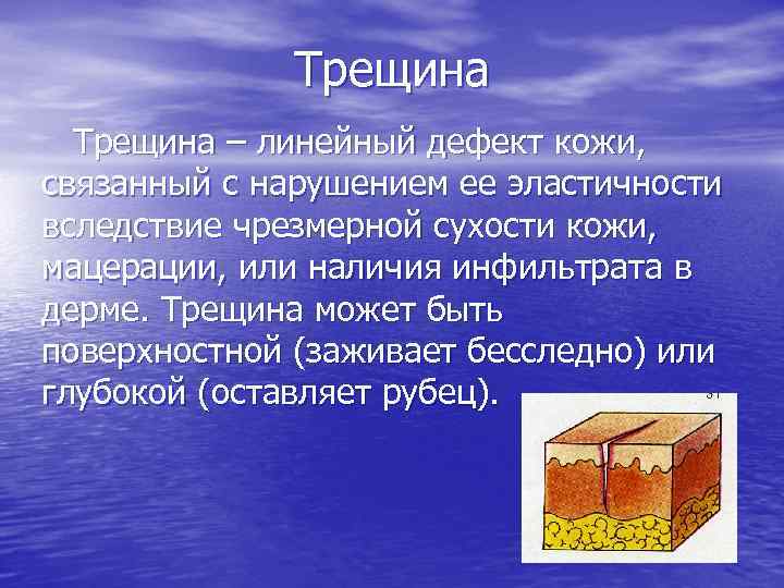 Трещина – линейный дефект кожи, связанный с нарушением ее эластичности вследствие чрезмерной сухости кожи,