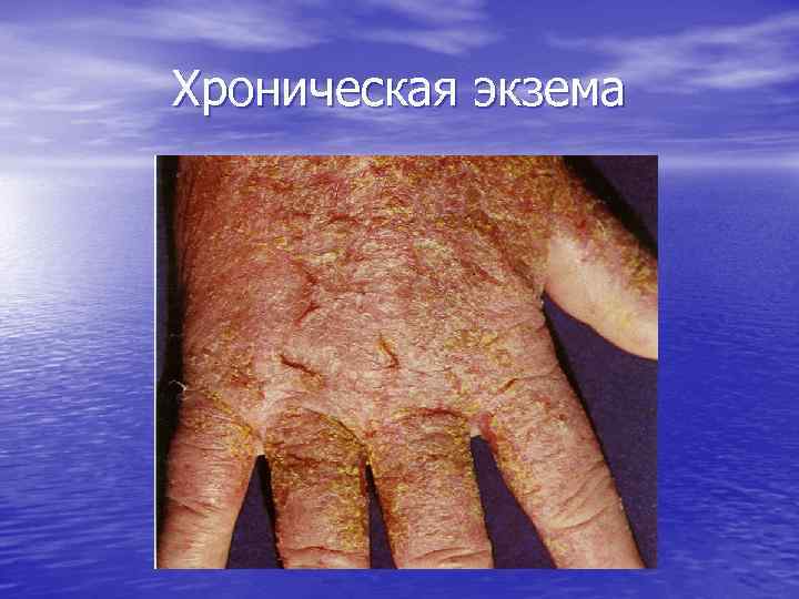 Хроническая экзема 
