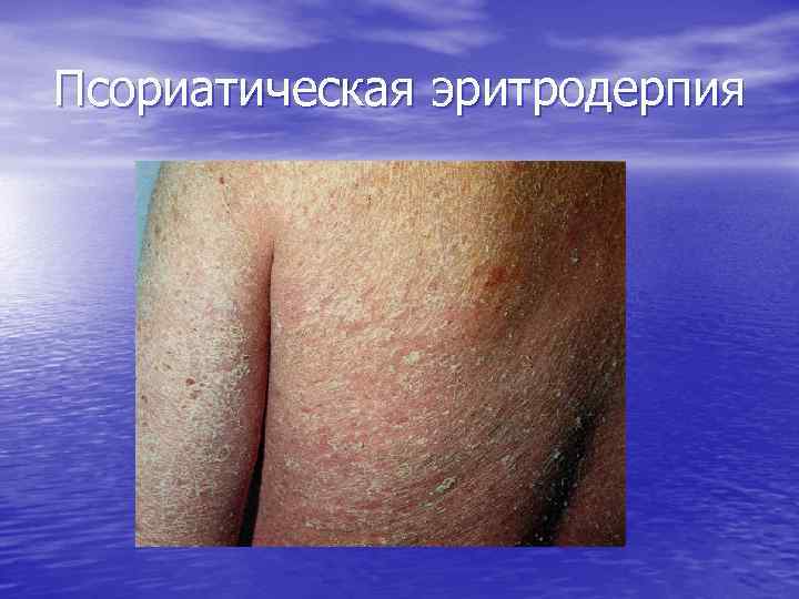 Псориатическая эритродерпия 