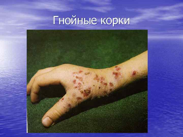 Гнойные корки 