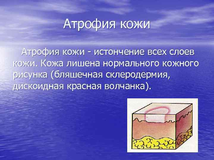 Атрофия кожи истончение всех слоев кожи. Кожа лишена нормального кожного рисунка (бляшечная склеродермия, дискоидная