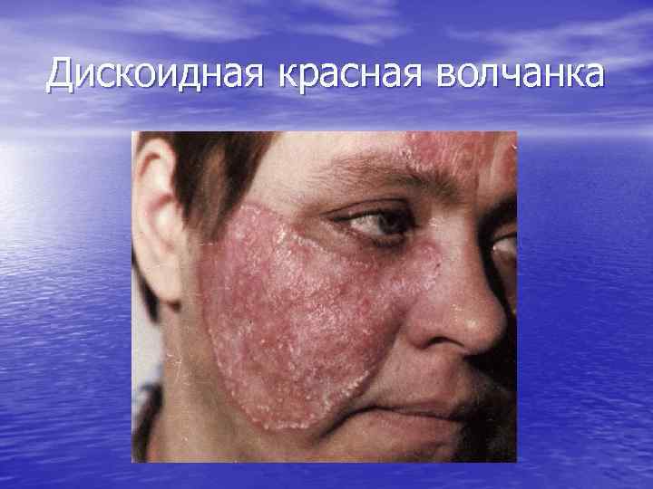 Дискоидная красная волчанка 